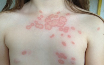 Površinske glivične okužbe kože