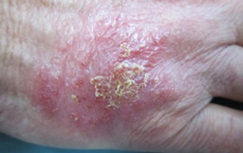 Glivične okužbe kože
