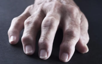 Diagnosticiranje revmatoidnega artritisa